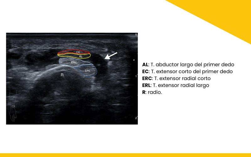 Síndrome Intersección Distal Y Ecografía Tempo Formación 3807